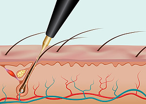 Schematische Darstellung des Behandlungs-Ablaufs