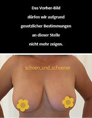 Ersatz Vorher-Nachher-Foto