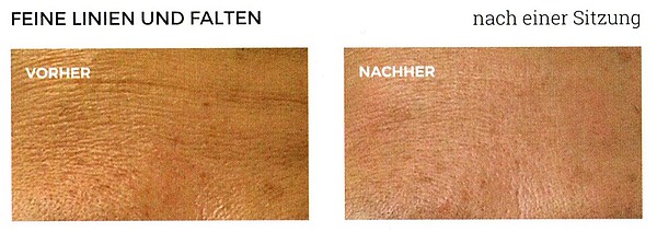 Feine Linien und Falten vorher-nachher