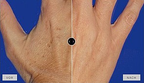 Ergebnis MesoPeel TCA 35 %