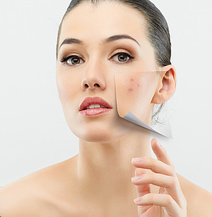 Hauterneuerung durch Chemisches Peeling