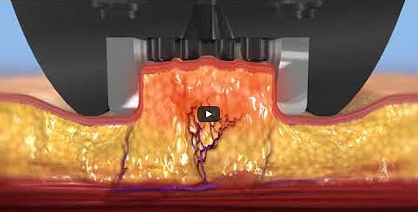 BODY fx™- Animation