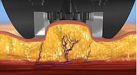 BODY fx™ - Behandlungsschritte
