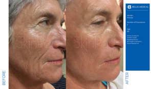 MicroNeedling | medizinisch bei Schön & Schöner | Stuttgart