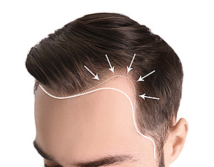 Vorteile der Dr.CYJ-Hairfiller-Behandlung
