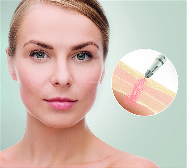 Dermadrop BIOBTX-Behandlung