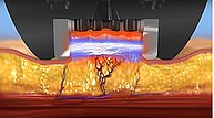 BODY fx™ - Behandlungsschritte