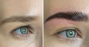 Ergebnisse Brow Lifting