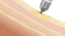 Wirkweise TDA Transdermaleapplikation