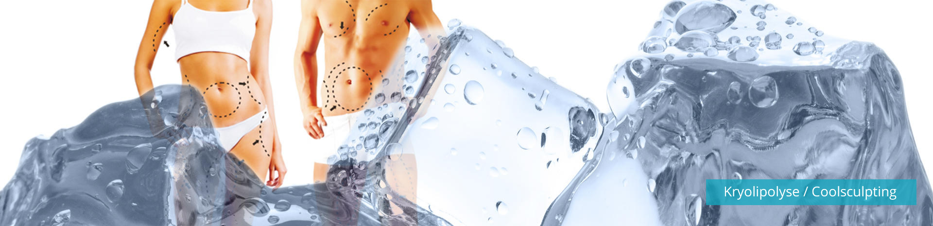 Kryolipolyse und Coolsculpting