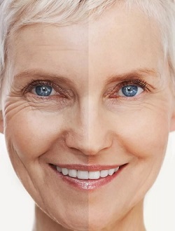 Softfiller Karisma
