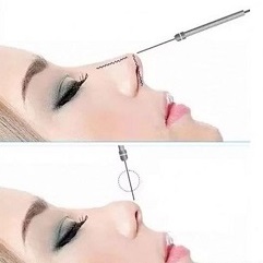 Faden-Lifting Nase
